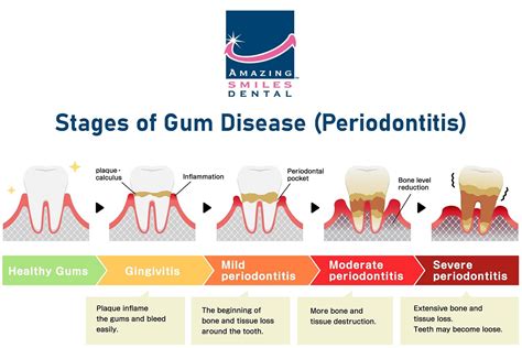 gum disease treatment near me|Periodontal Disease (Gum Disease): Causes, Symptoms.